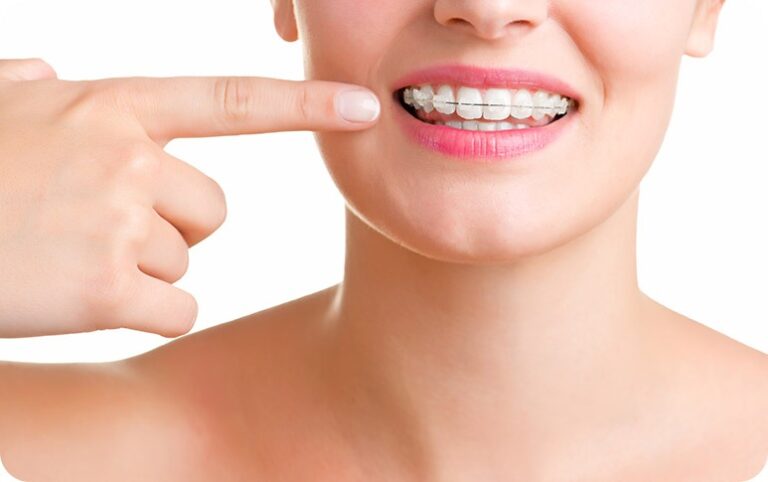 a lady pointing towerds her teeth after implementing braces