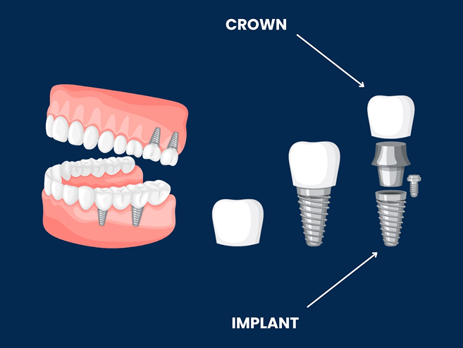 dental implants demo