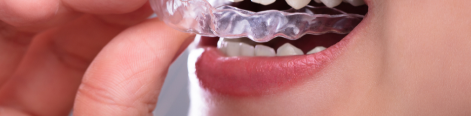 Why Should You Consider Wearing a Night Guard